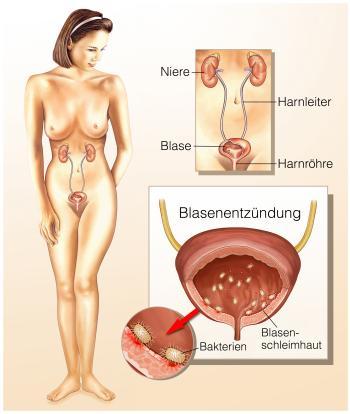 Zu sehen ist das Bild 1 des Beitrags mit dem Thema: Blasenentzündungen